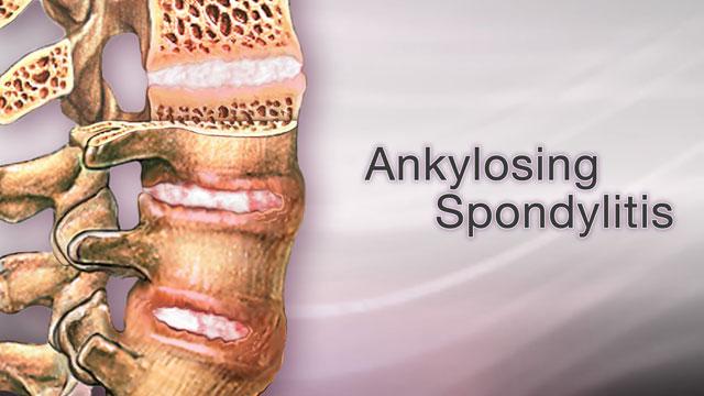 Ankylosing Spondylitis: A Comprehensive Guide