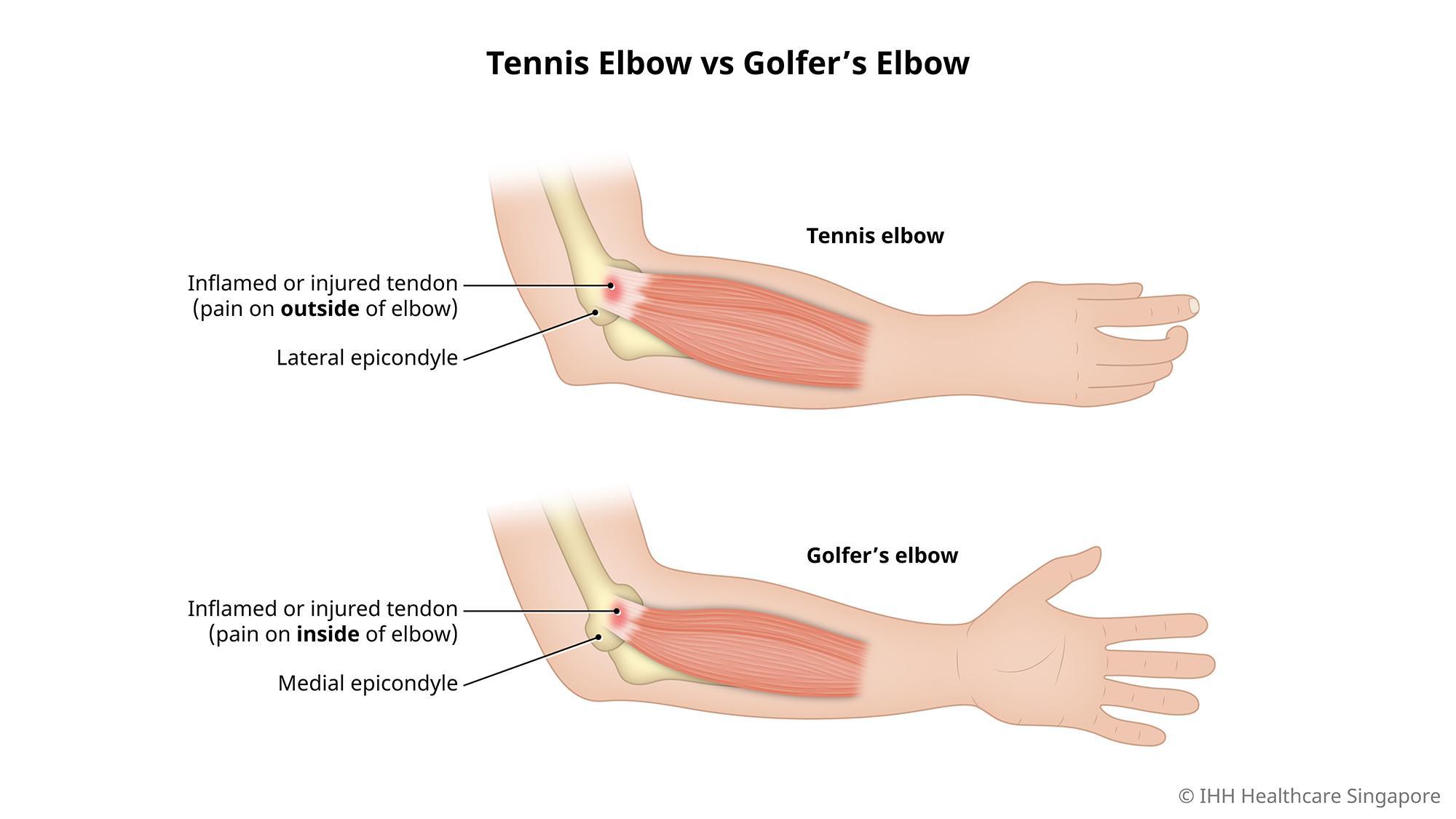 Effective Tennis Elbow Treatment with Homeopathy: A Gentle Approach to Healing