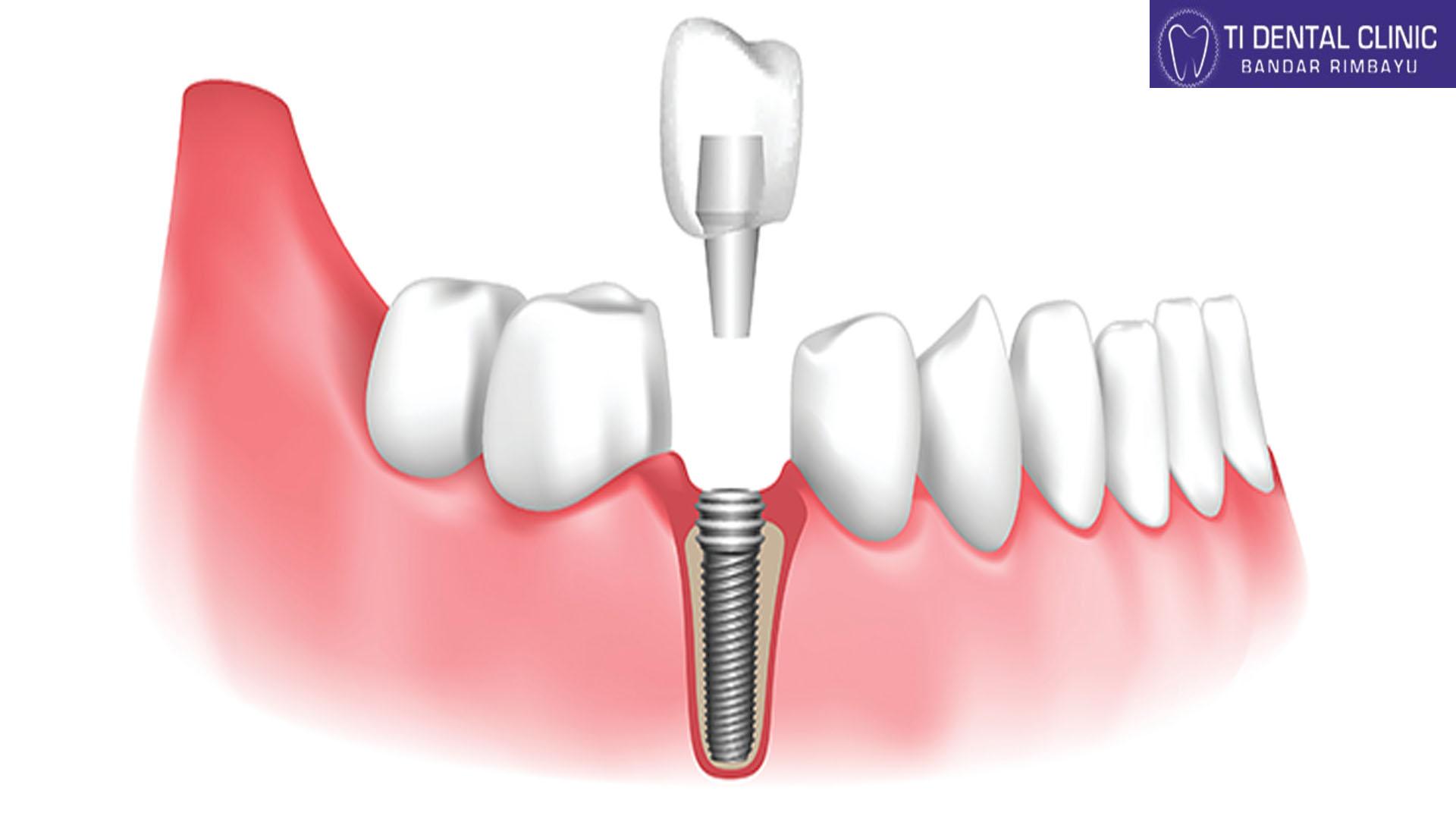 Implant Teeth: Precision and Perfection for Your Smile (Tidental)