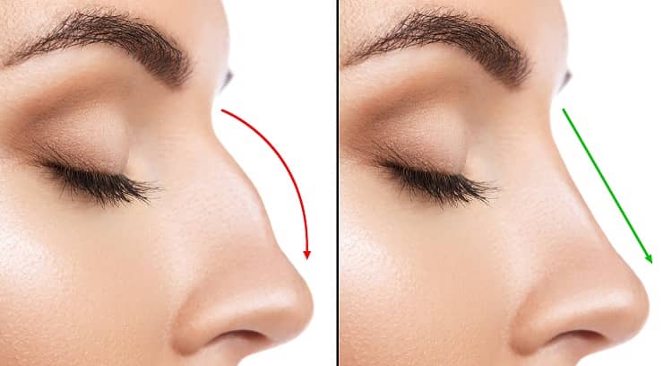 Dubai’s Rhinoplasty Marvels: Enhancing Beauty, Boosting Confidence